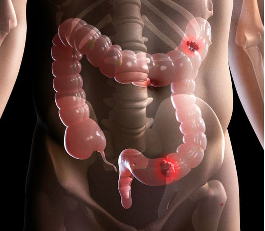Limpieza del Colon, como se hace